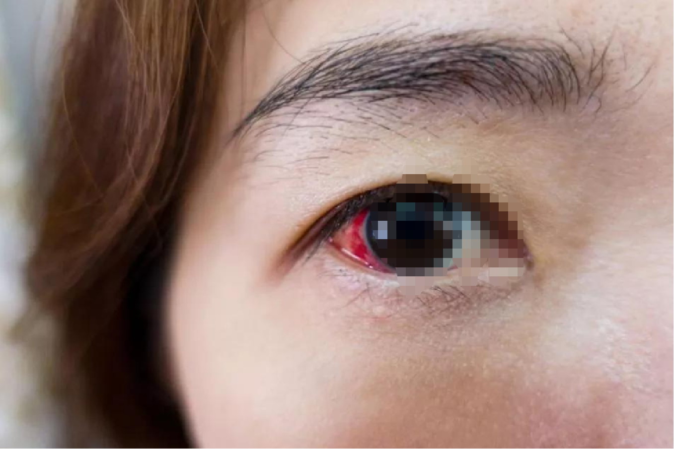 炎症引起眼睛淤血图片