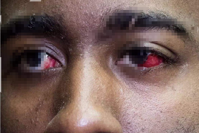 外伤引起眼睛淤血图片