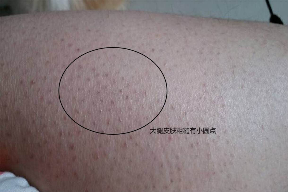 大腿皮肤粗糙有小圆点图片