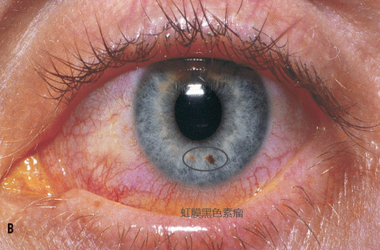 虹膜黑色素瘤图片