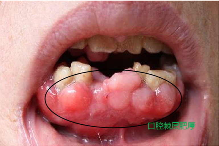 口腔棘层肥厚图片
