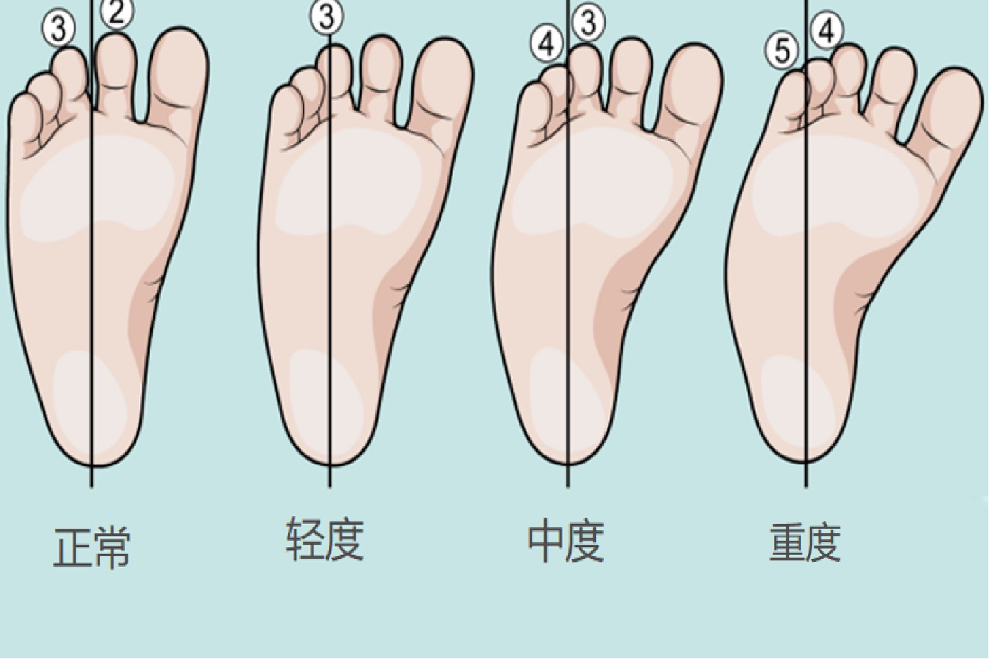 正常脚与各种足内翻对比图