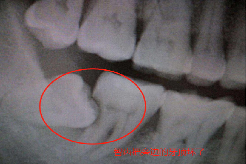 智齿把旁边牙顶坏的图片