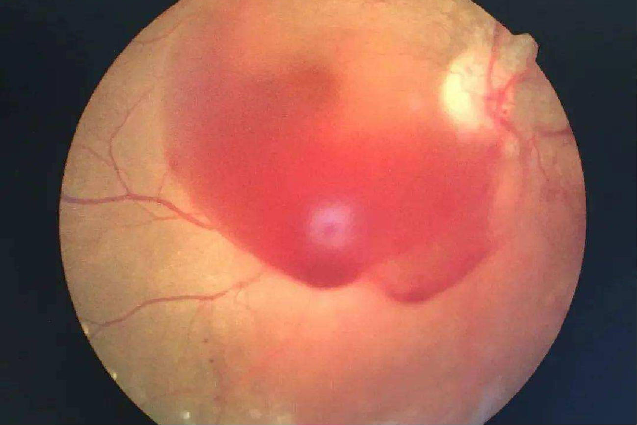 玻璃体出血图片