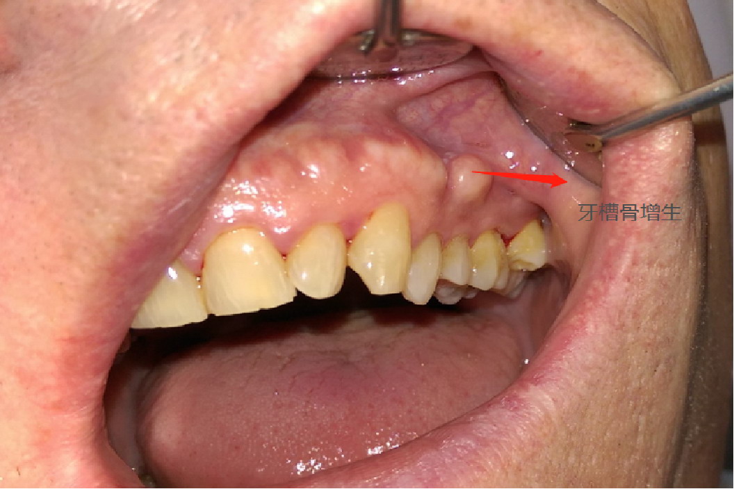 牙槽骨增生硬疙瘩图片