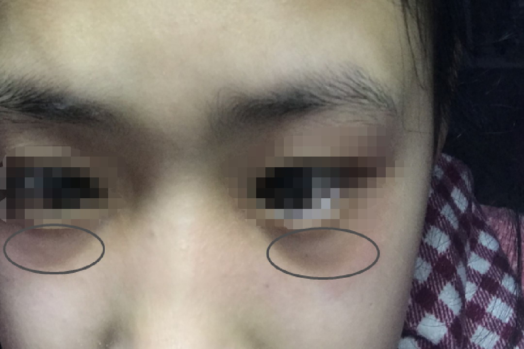 下眼睑发青图片