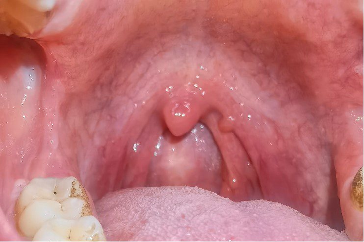 正常扁桃体示意图