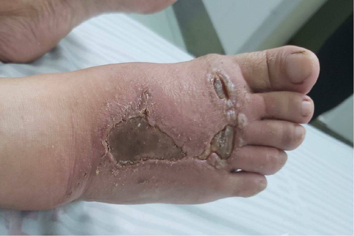 皮肤软组织坏死照片