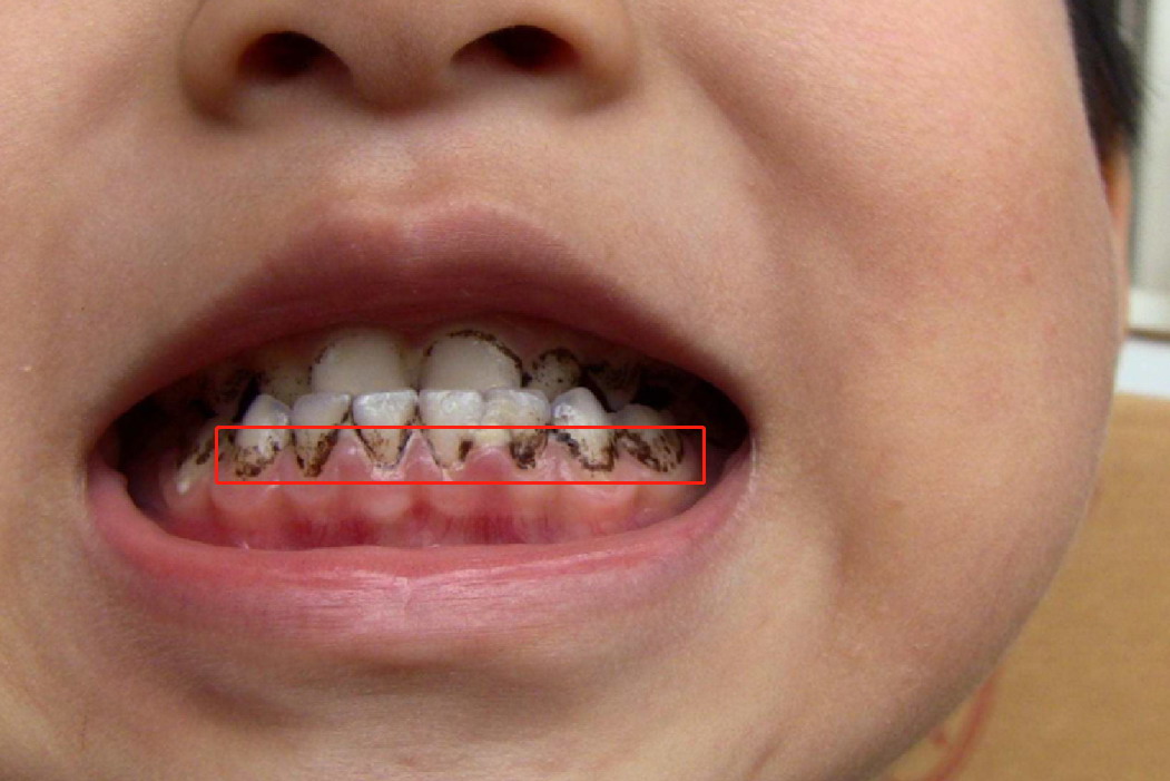 牙齿底部部分被腐蚀图片