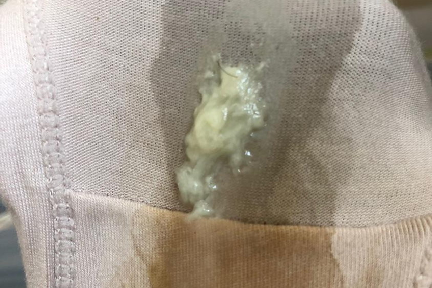 阴道有白色分泌物图片