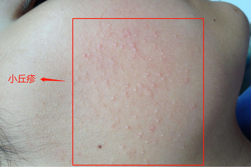 小丘疹早期症状图片