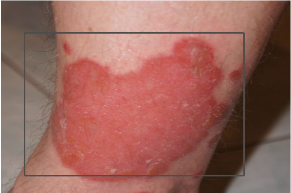 寻常型银屑病薄膜现象图