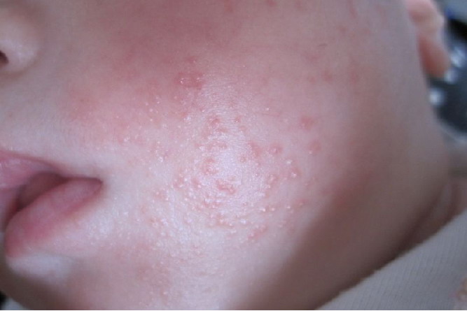 奶疹图片