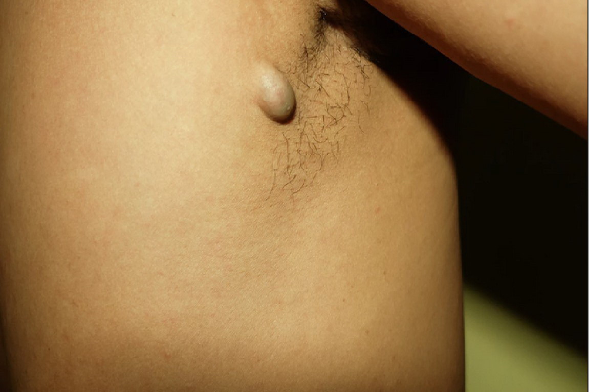 良性腋下淋巴瘤图