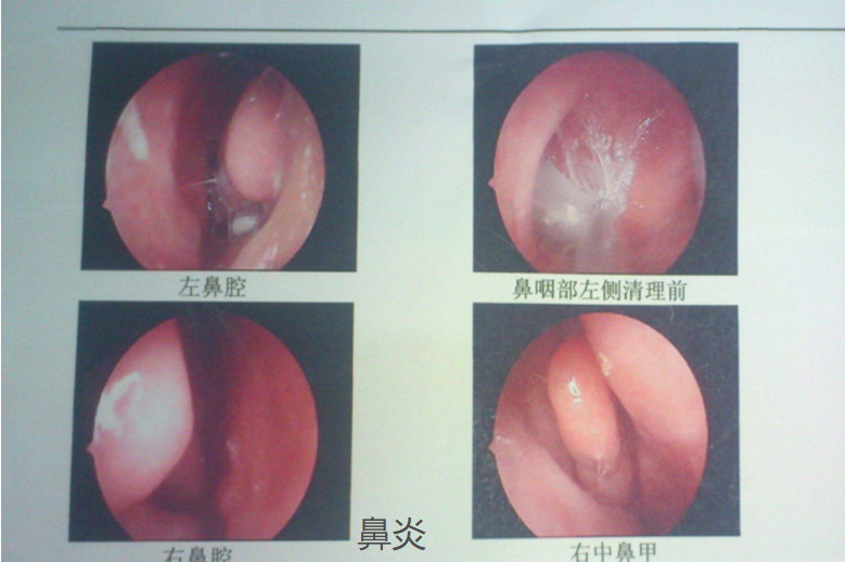 鼻炎严重图片