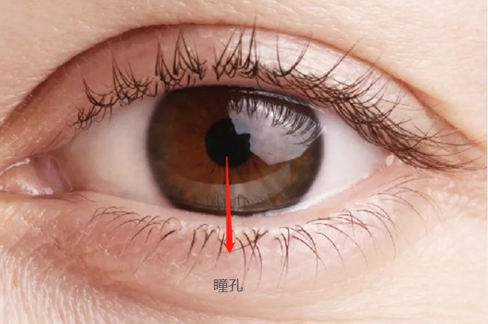 眼科概述瞳孔不散开是正常的状态,正常人瞳孔直径为2