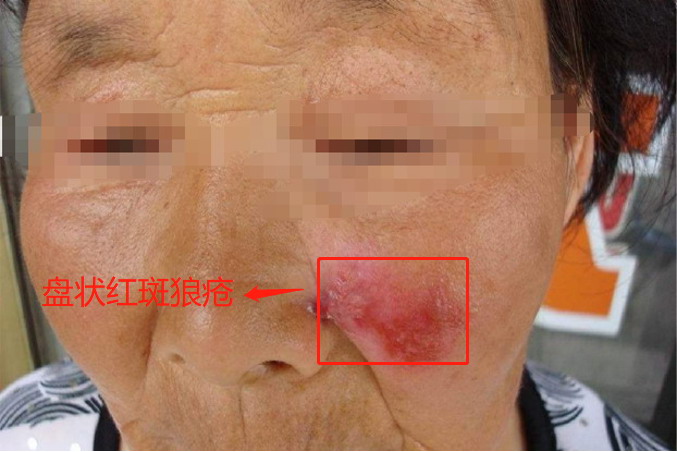 盘状红斑狼疮最初症状图