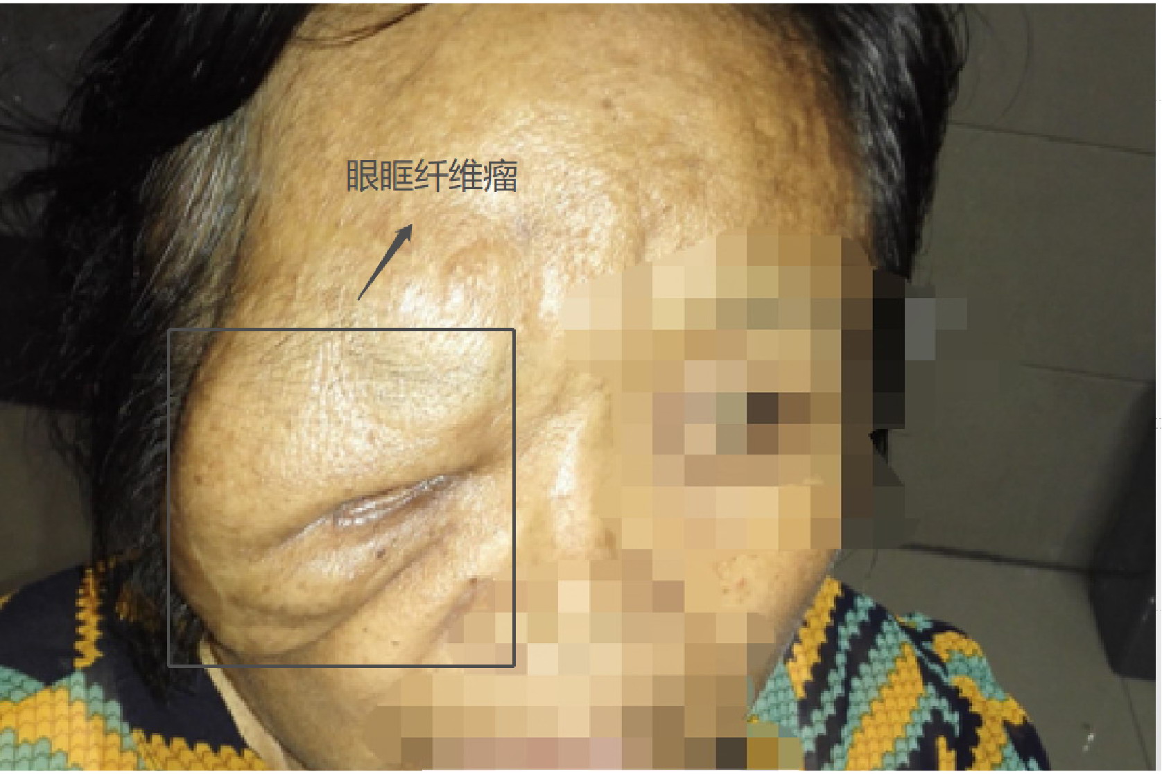 眼眶神经纤维瘤图片