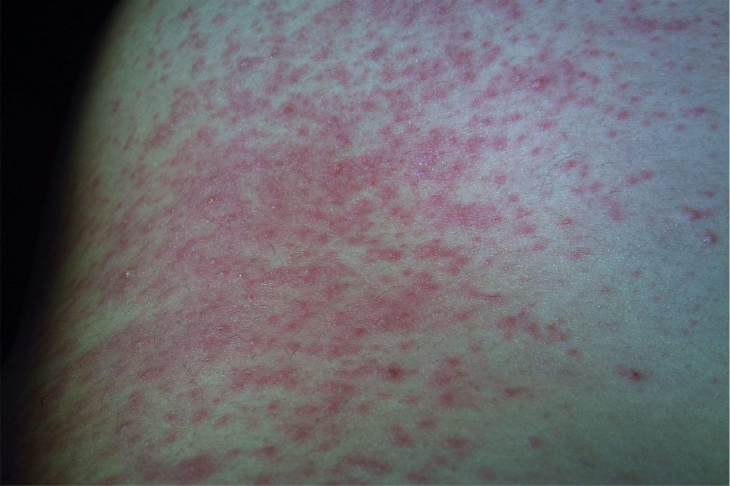 湿疹的症状 初期图片