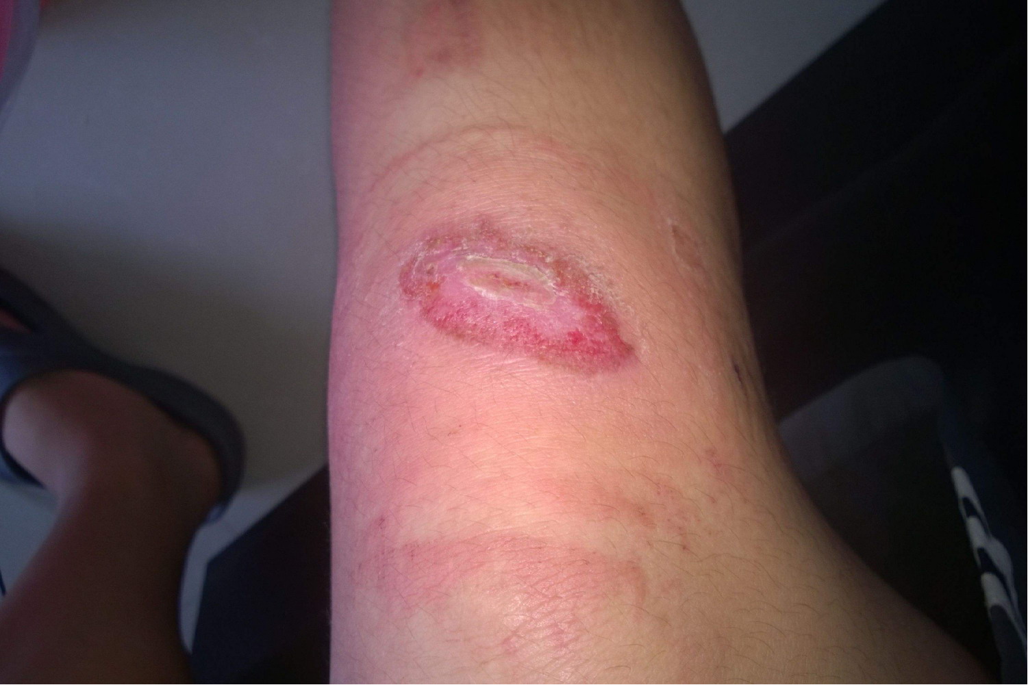 创伤愈合处长疹子图片