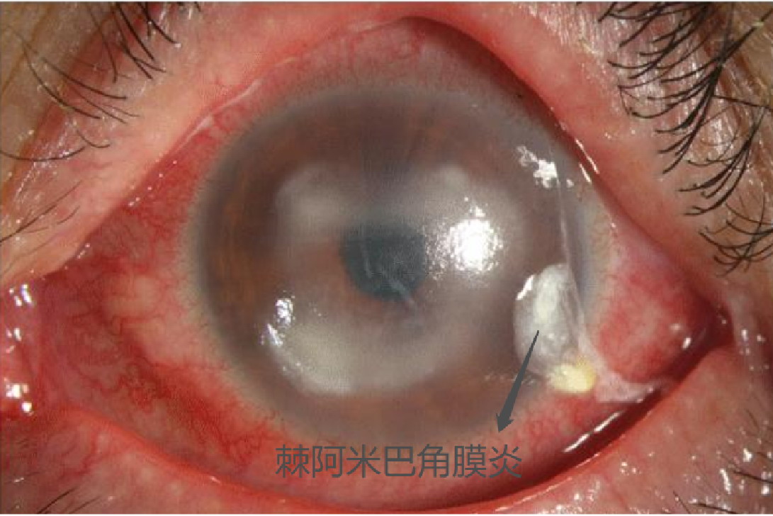 棘阿米巴角膜炎图片