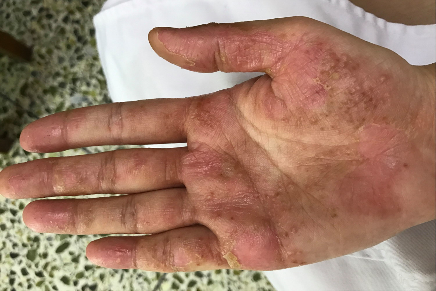 掌跖脓疱病的图片