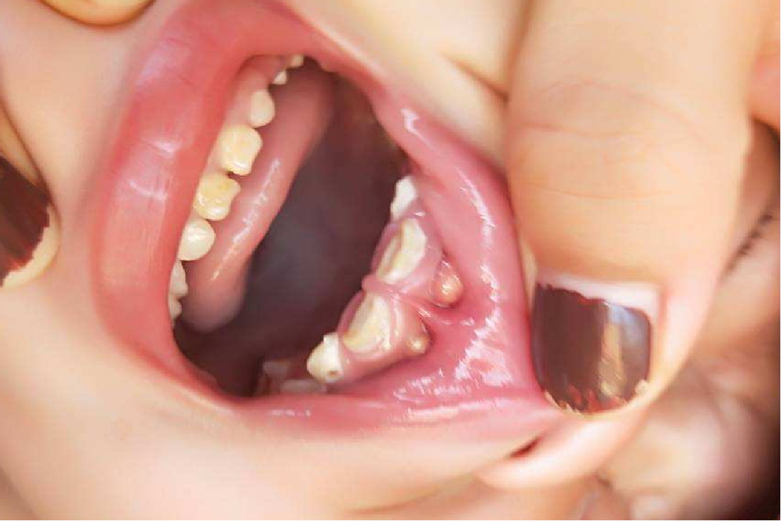 牙齿下面长白泡图片