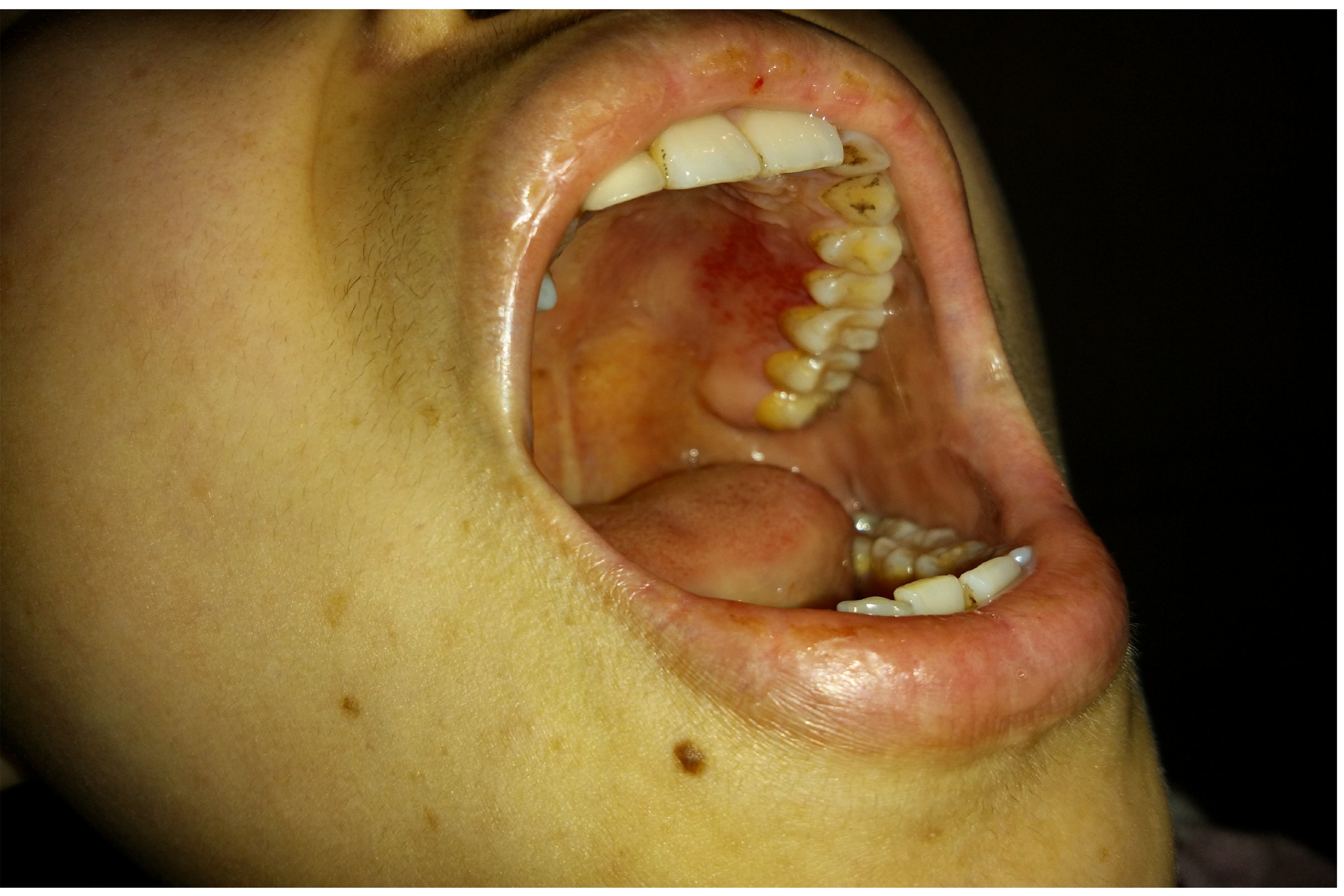 口腔出血:口腔出血可能发生在牙龈,黏膜等部位,可能存在继发感染的