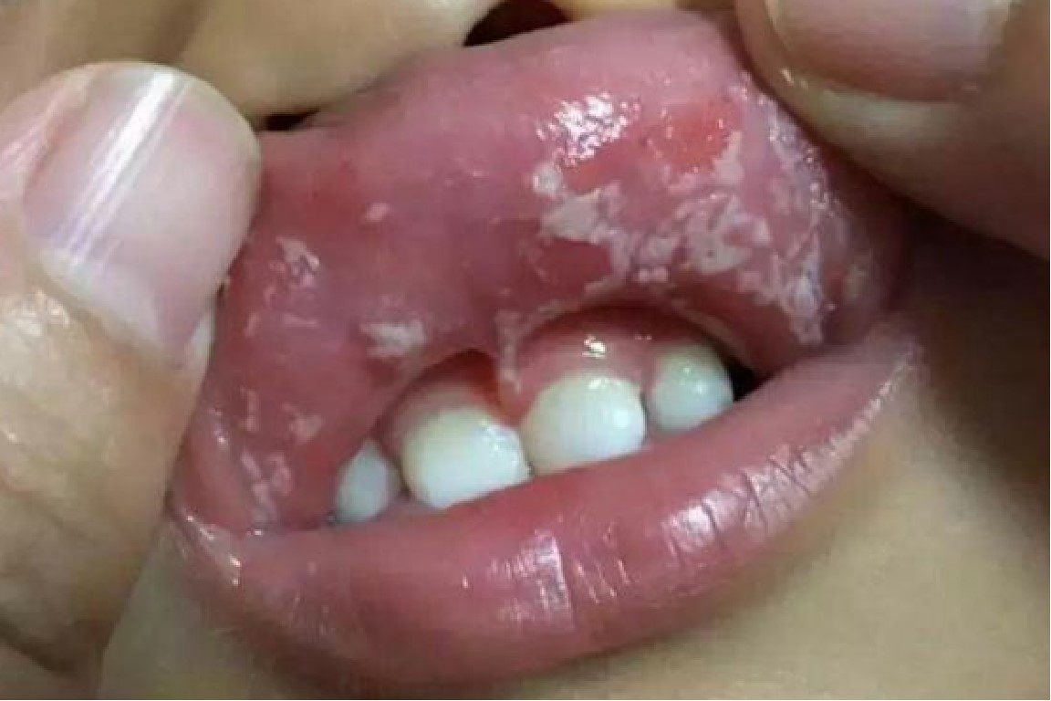 婴儿鹅口疮图片