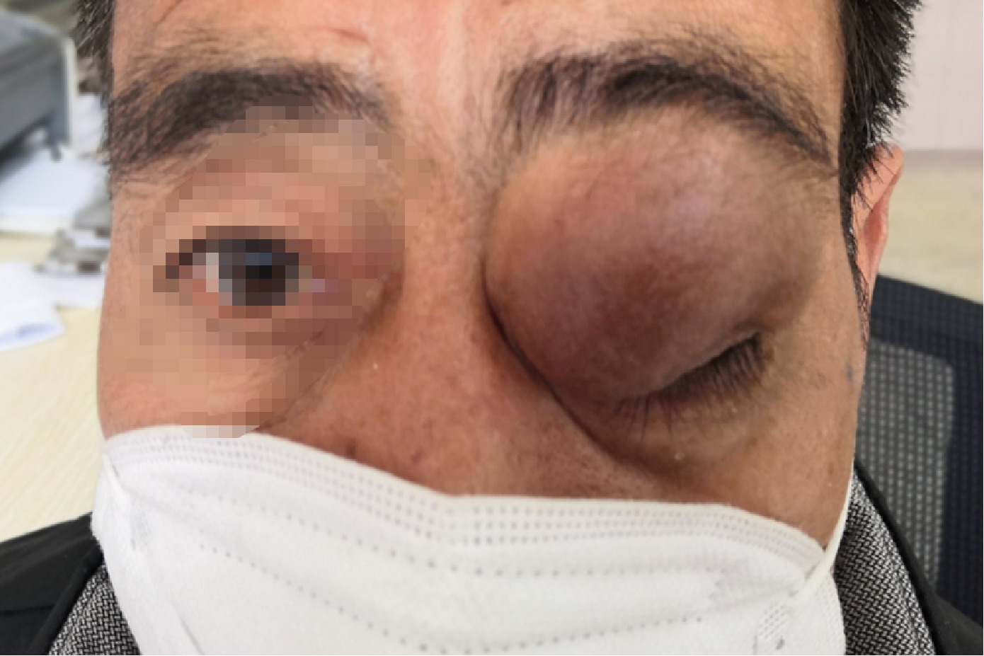 眼眶恶性肿瘤图片