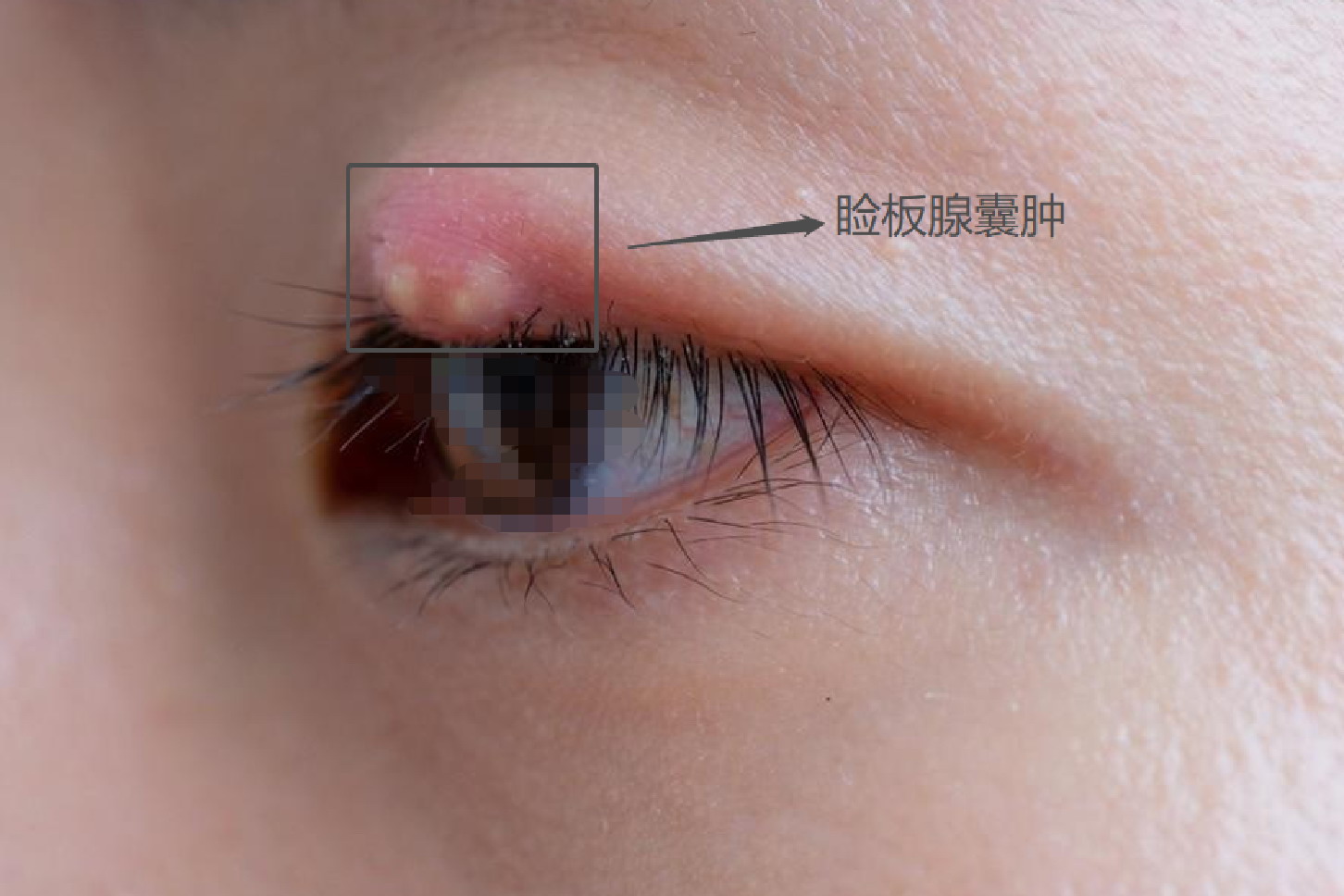 上眼皮睑板腺囊肿