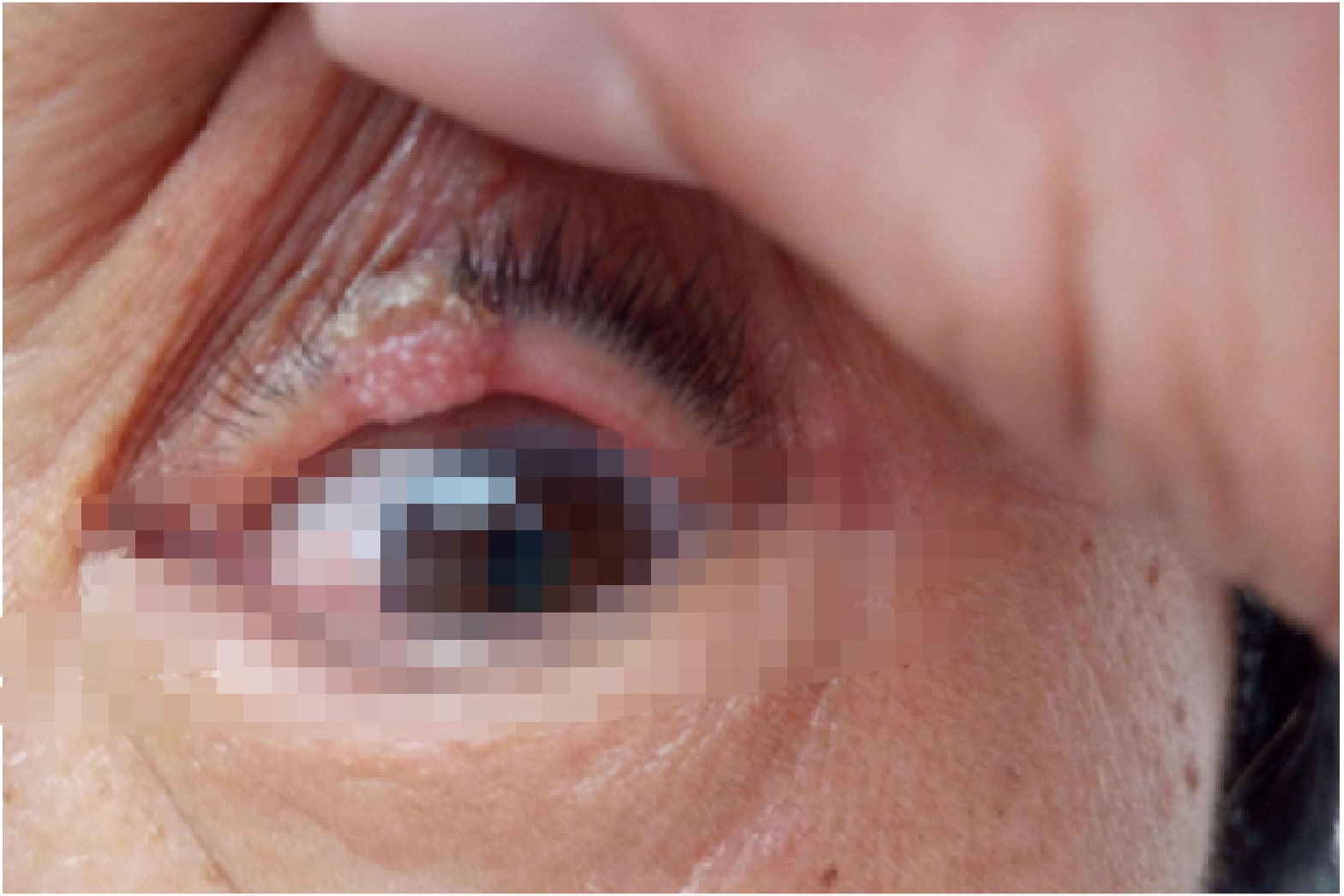 上眼皮内蚊虫叮咬肉芽肿