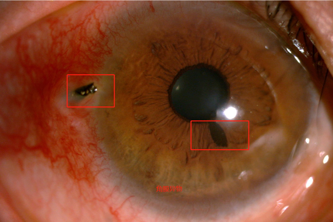 角膜异物图片