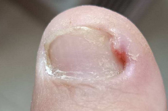 甲沟炎长肉芽初期图片