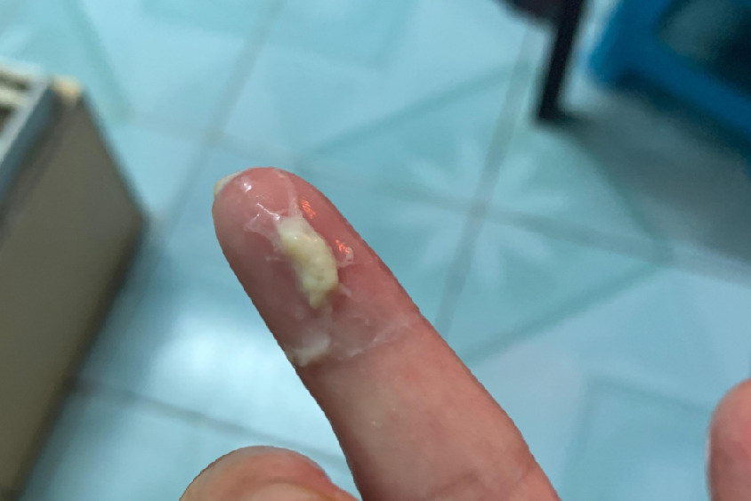 阴道排出像豆腐皮图