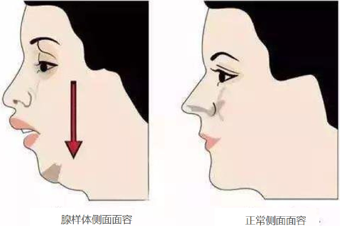 腺样体侧面面容图片