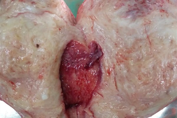 子宫息肉真实图片