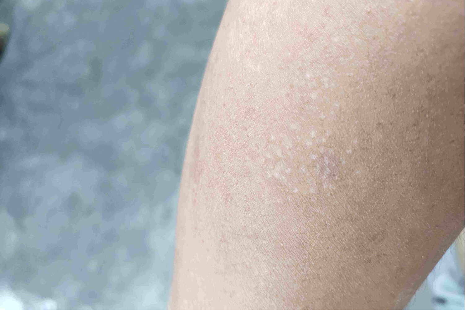 手臂上长小白点图片