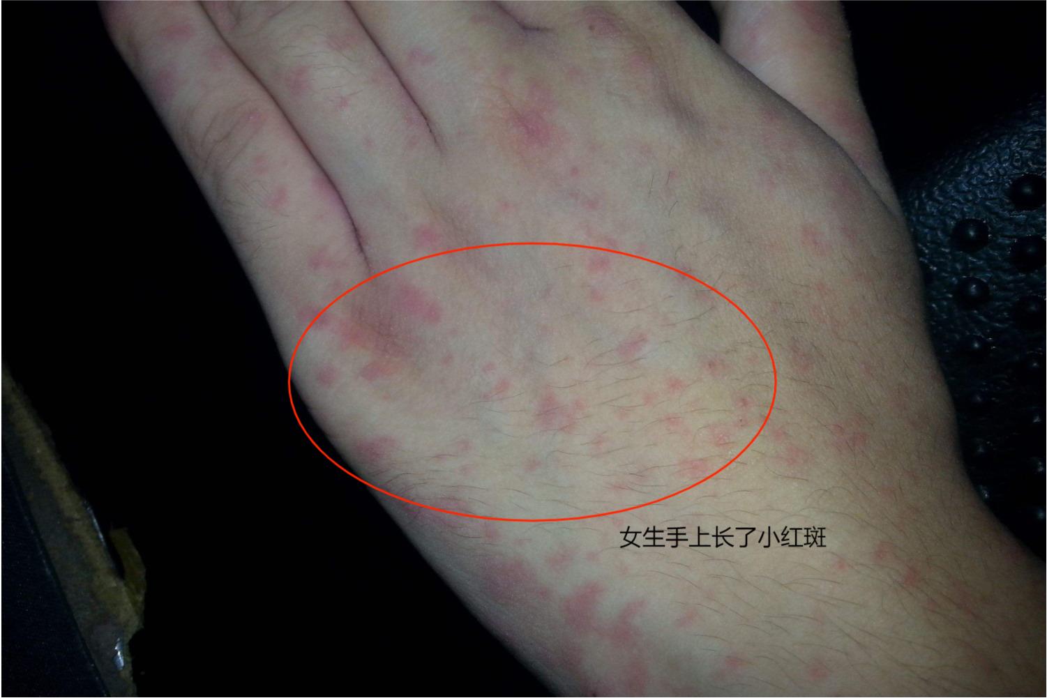 女生手上长了小红斑图片