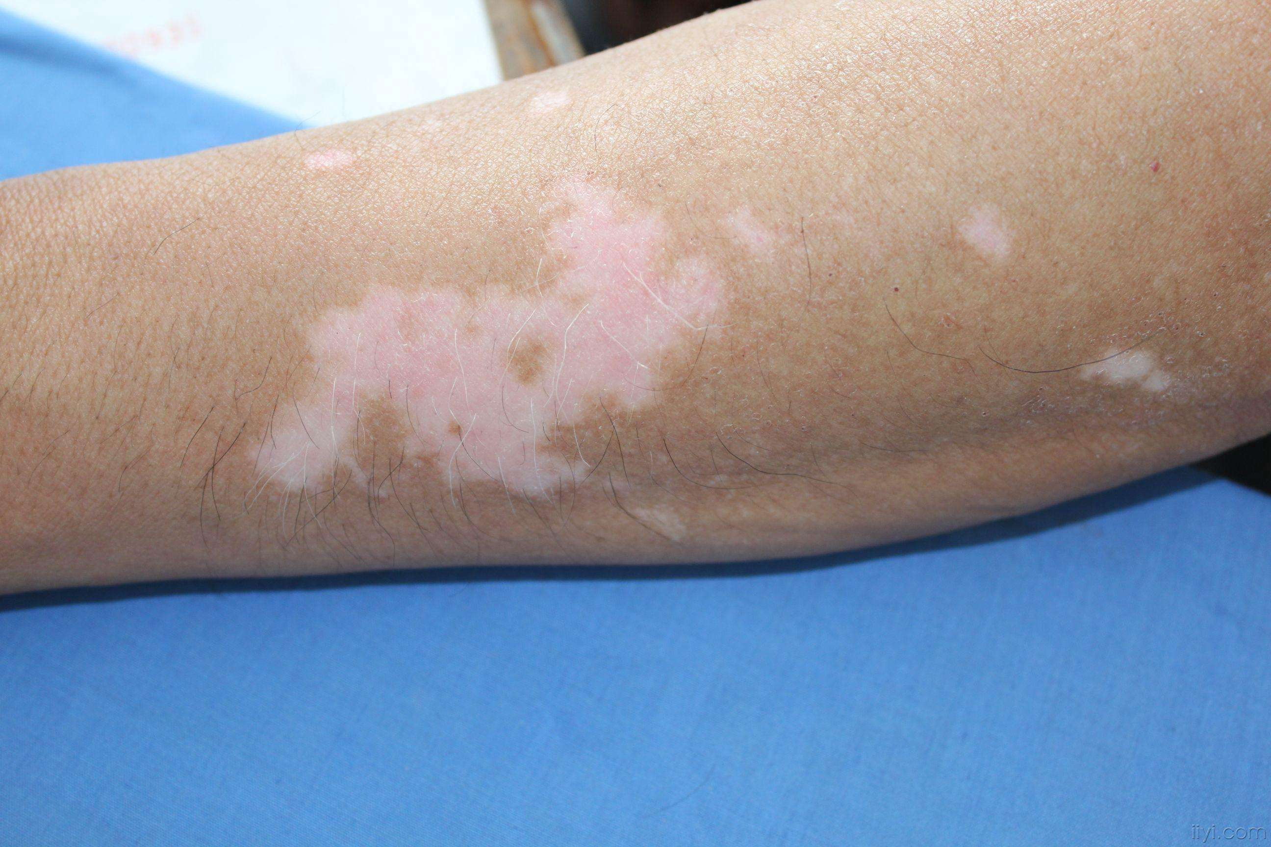 节段型白癜风图片