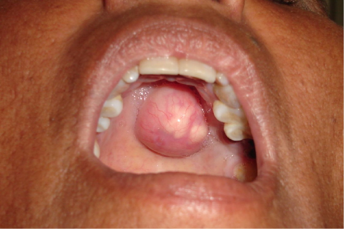 口腔上颚混合瘤图片