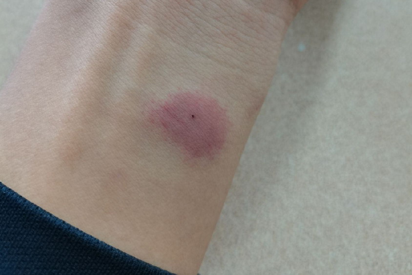 皮试红肿图片