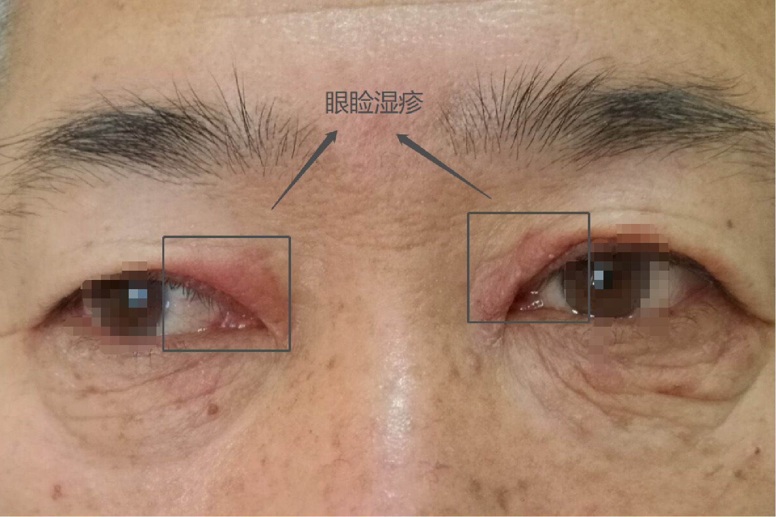 眼睑湿疹水疱图片