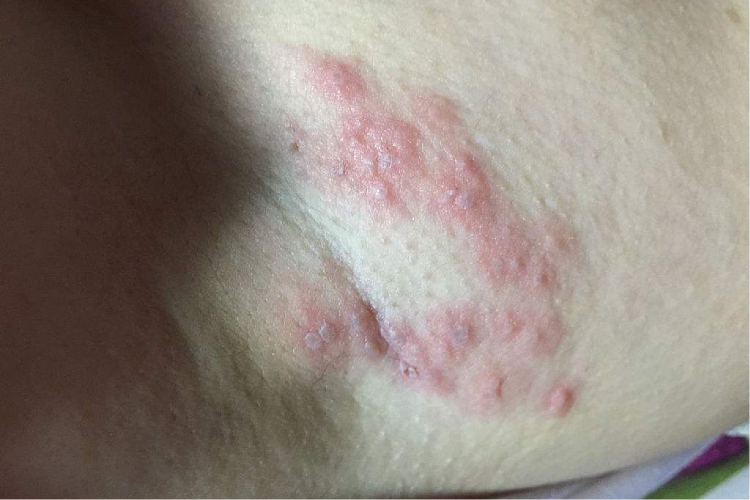 腋下长透明小水泡图片