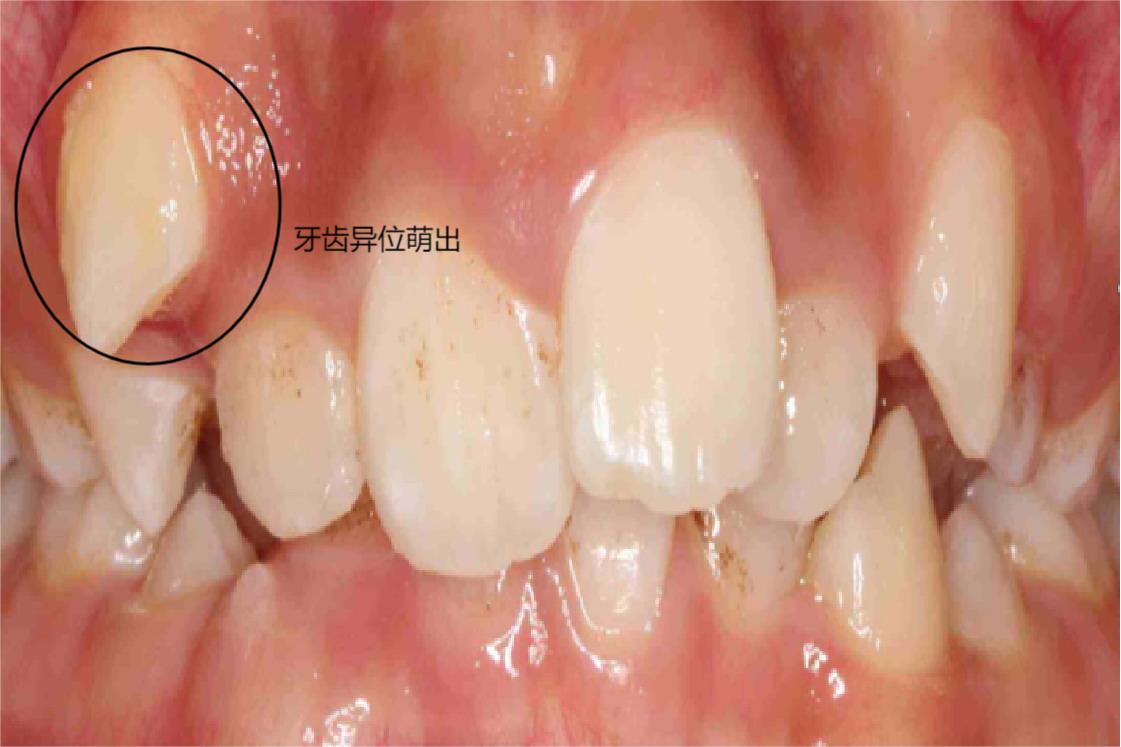 中国医科大学附属口腔医院「三级甲等」 口腔科概述上颚牙齿异位萌出