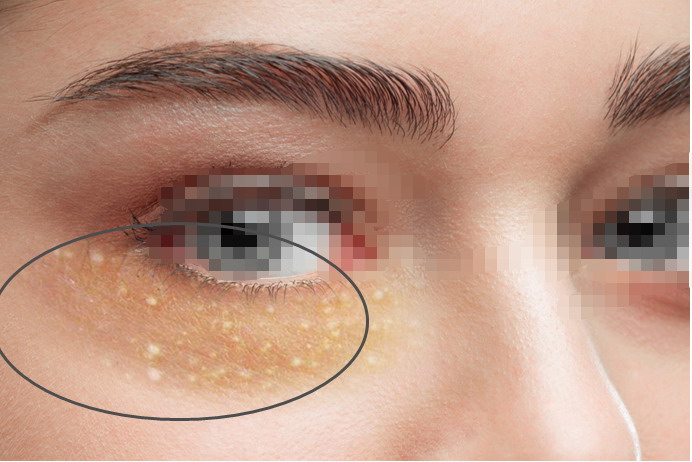 眼角旁长粟丘疹图片