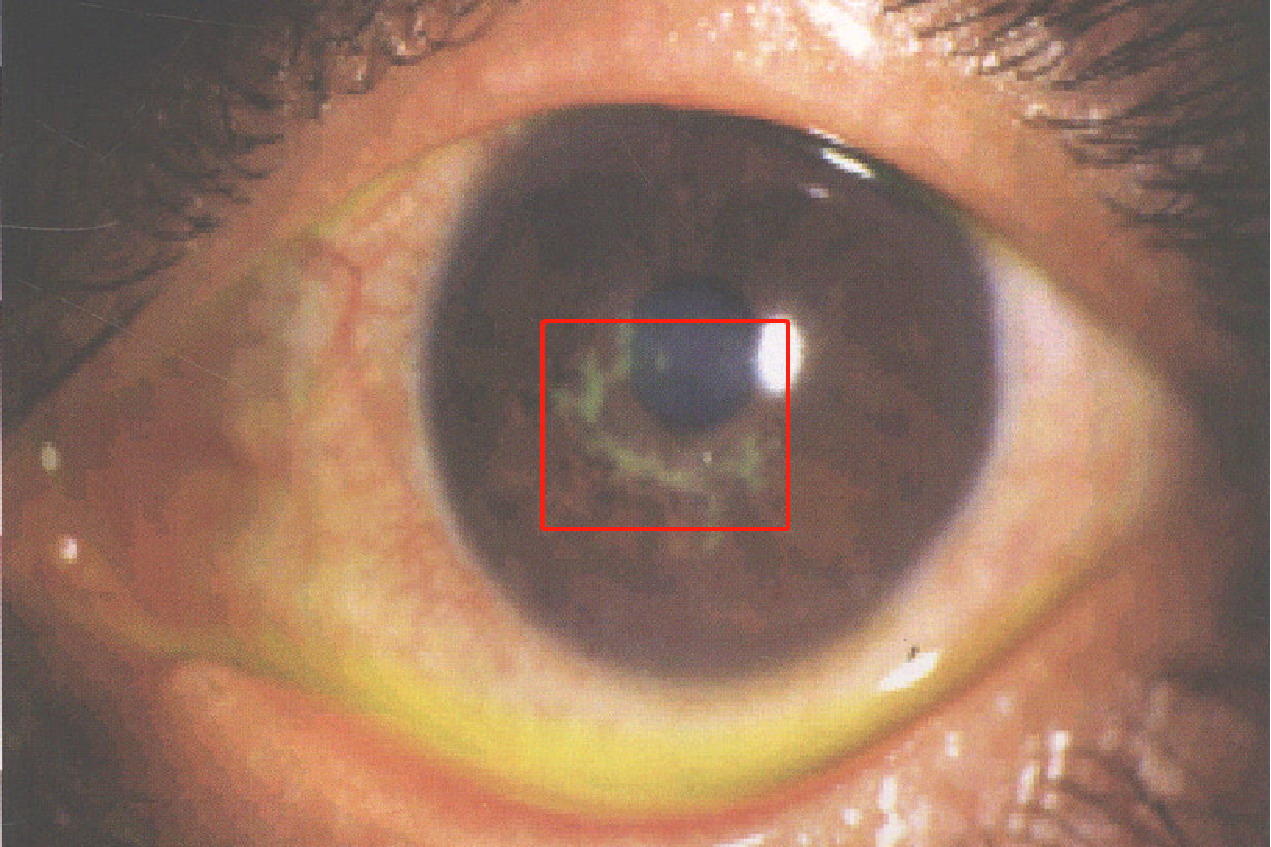 细菌感染角膜浸润图片