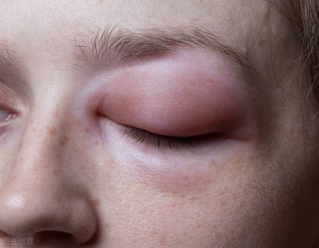 水分或者泪液在眼睛周围堆积,可能会导致眼睛肿胀的症状出现