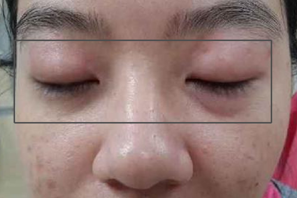 眼睛周围水肿图