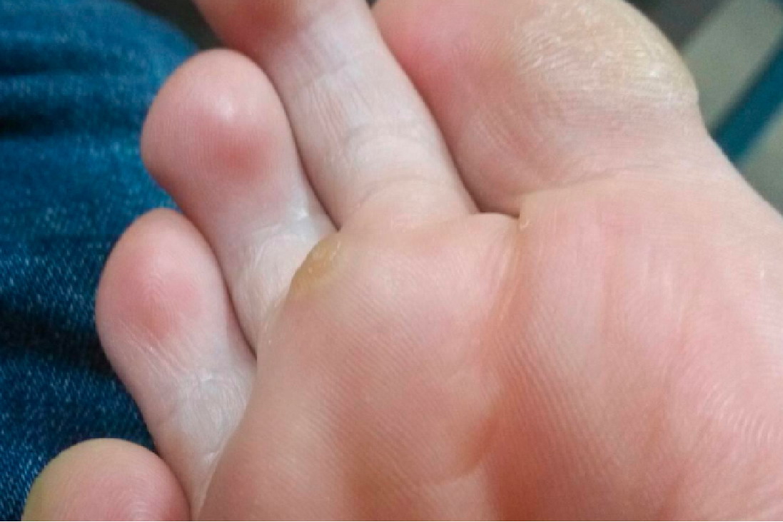 长鸡眼与恢复正常对比图